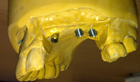 Replica implant without soft tissue to show angulations